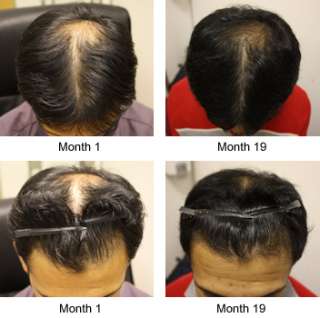 Energizer Hair Growth Booster & DHT Blocker for intense Hair loss 